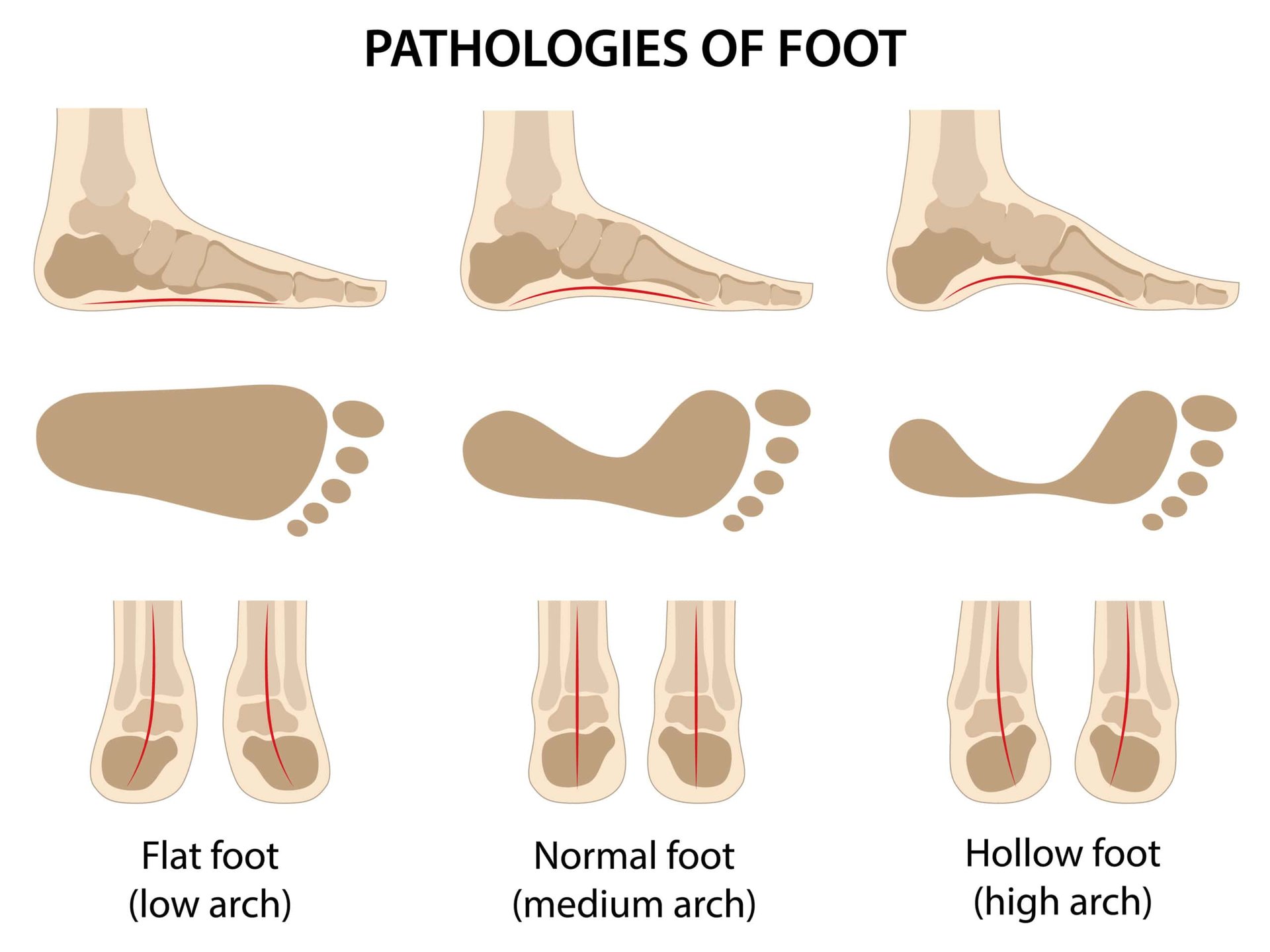 Flat Feet: Symptoms | Pain | Exercises | Treatments | Surgery