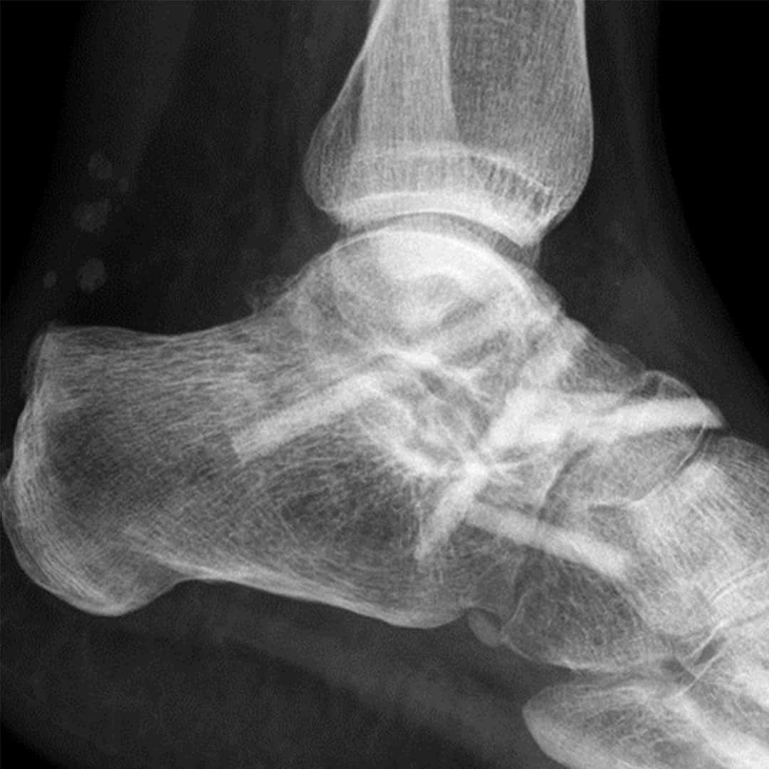 Triple-Arthrodese 8 Wochen postoperativ img-3