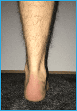 Plattfuß nach einer Plattfuß-Operation