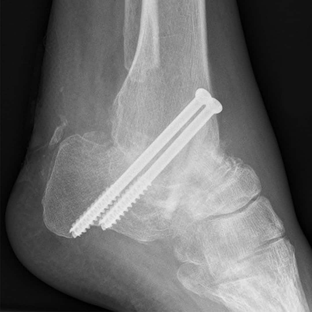 OSG & USG Arthrodese mit zwei Metallschrauben 3 Monate nach der Operation img-5