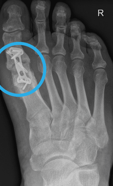 Pseudarthrose, Hallux rigidus, MTP 1 Arthrodese Metallschaube – Heilung Shark Screw®