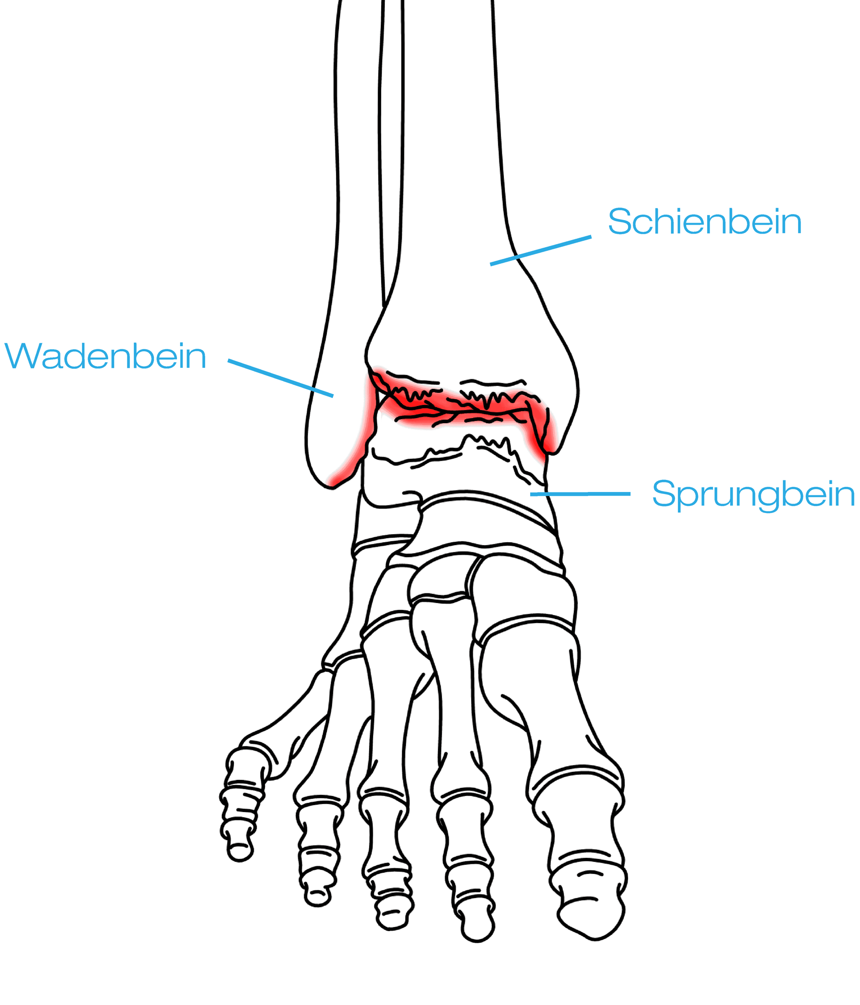 Sprunggelenk Arthrose img-6