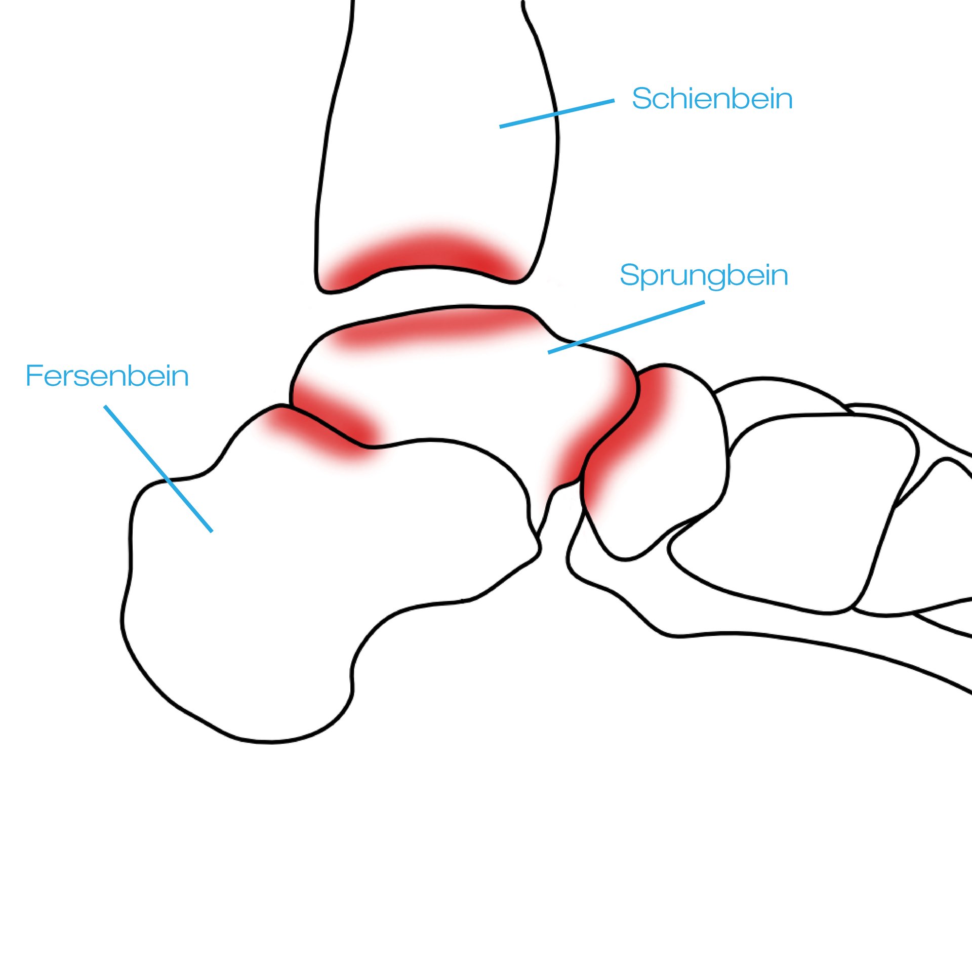 Arthrose im Sprunggelenk img-2