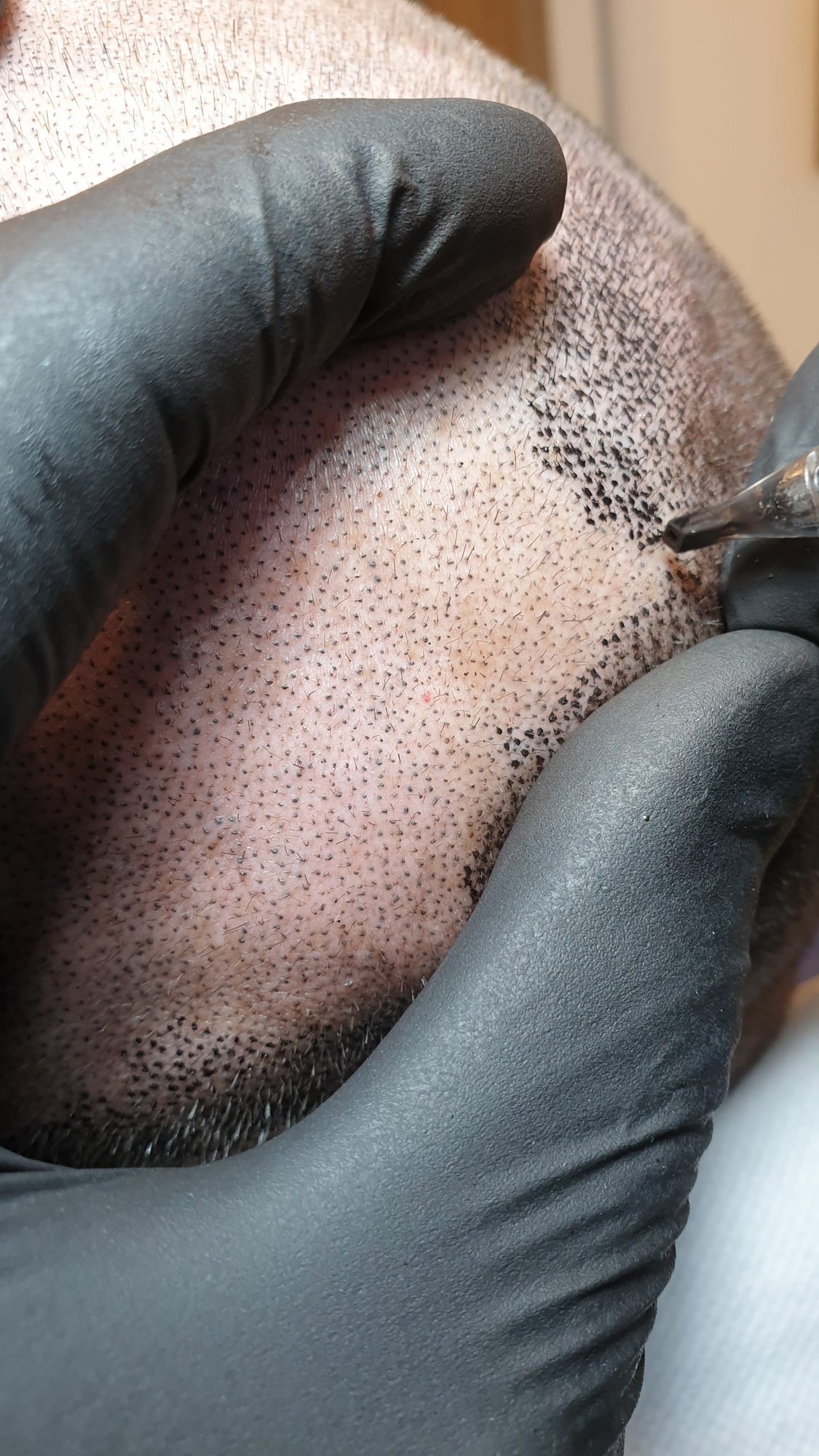 Tricopigmentazione: La Guida Completa 2025 (Costi, Risultati e Verità)