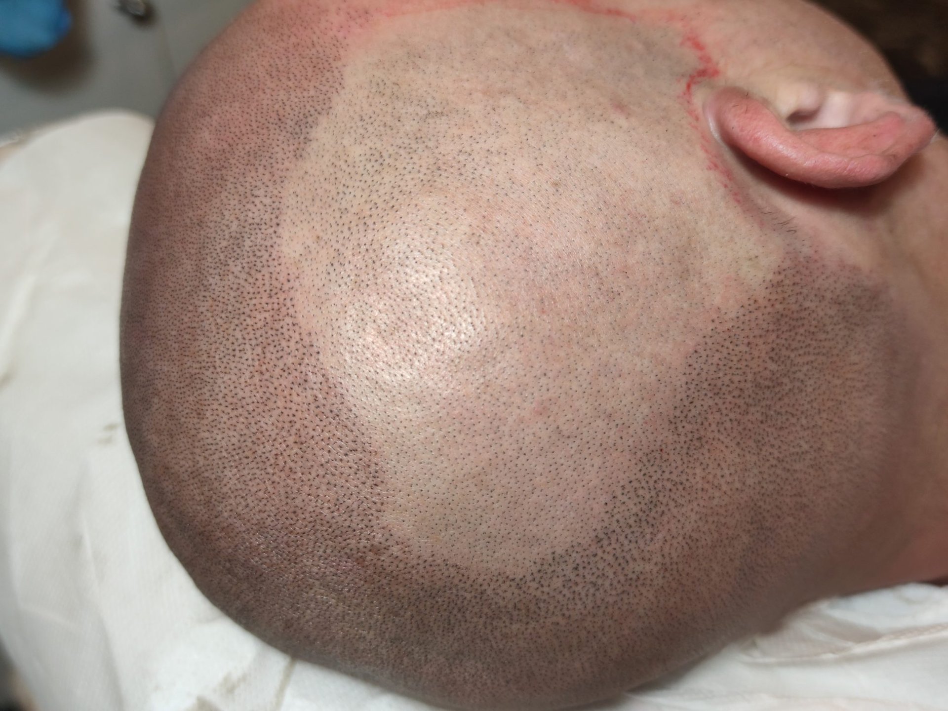 Tricopigmentazione: 7 Cose che Nessuno Ti Dice (Ma Dovresti Sapere)