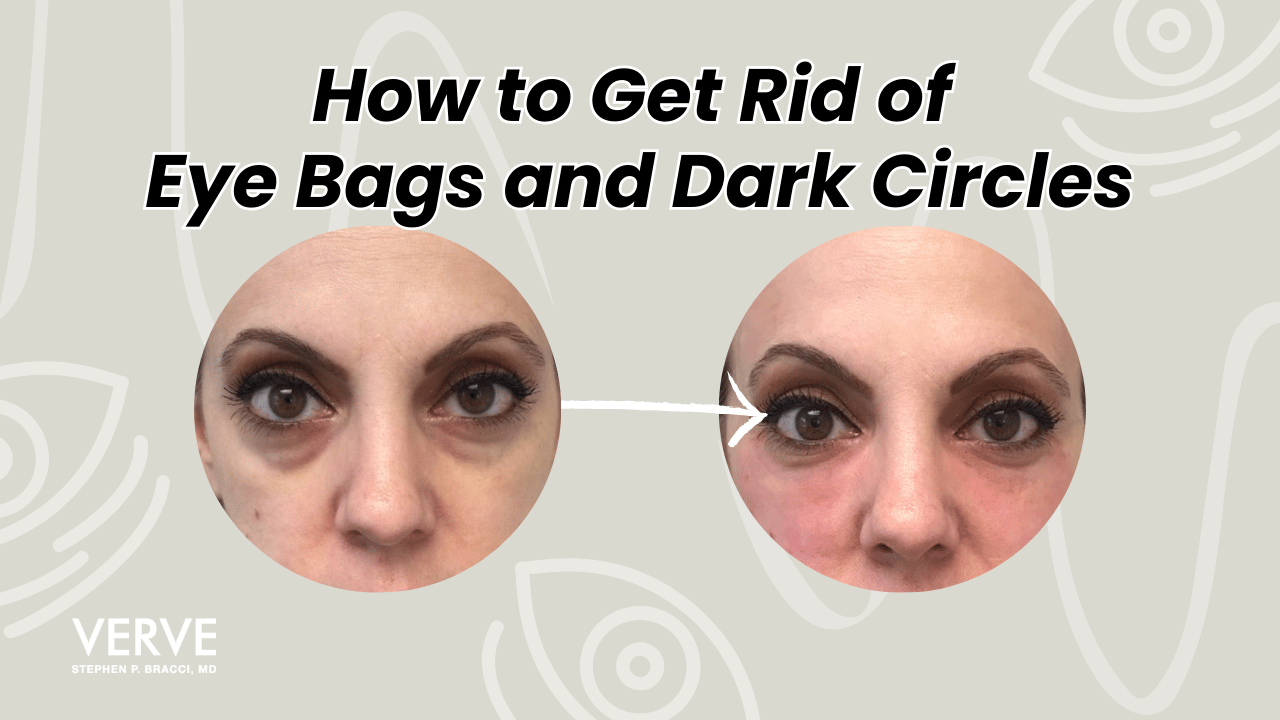 How to Get Rid of Bags Under Eyes and Dark Circles