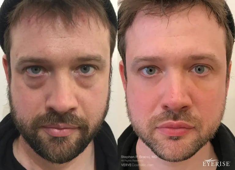 Non-Surgical-Eyebags-Removal-Dr-Bracci-1