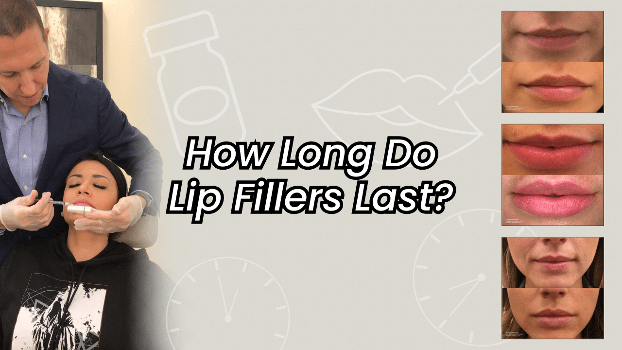 How Long Do Lip Fillers Last?