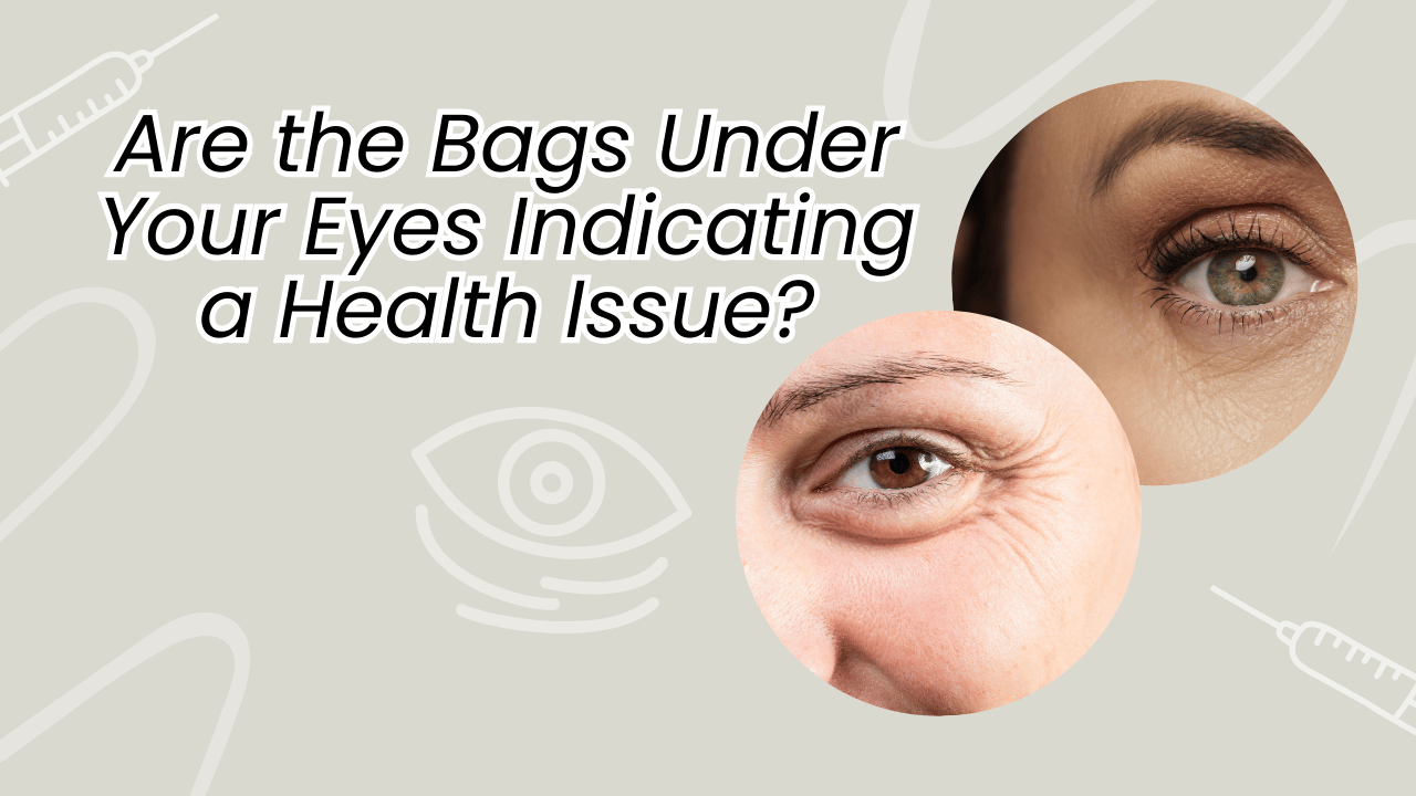 Are the Bags Under Your Eyes Indicating a Health Issue? | Tips to get rid of bags under eyes