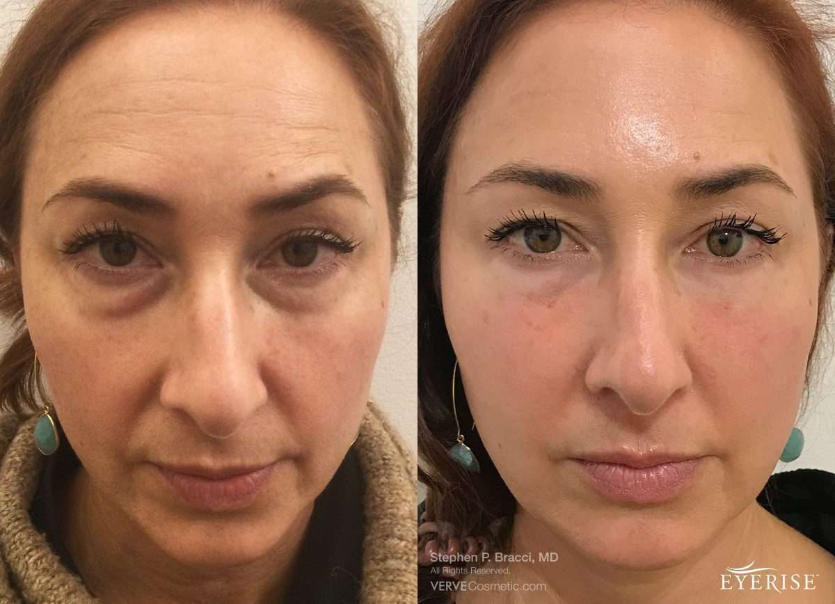 Laser Treatment For Eye Bags