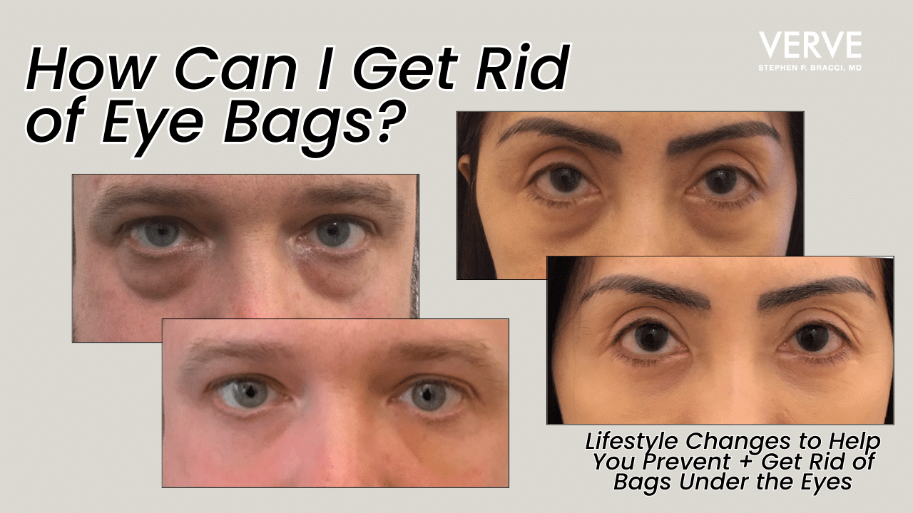 How Can I Get Rid of Eye Bags? | Lifestyle Changes to Help You Prevent + Get Rid of Bags Under the Eyes