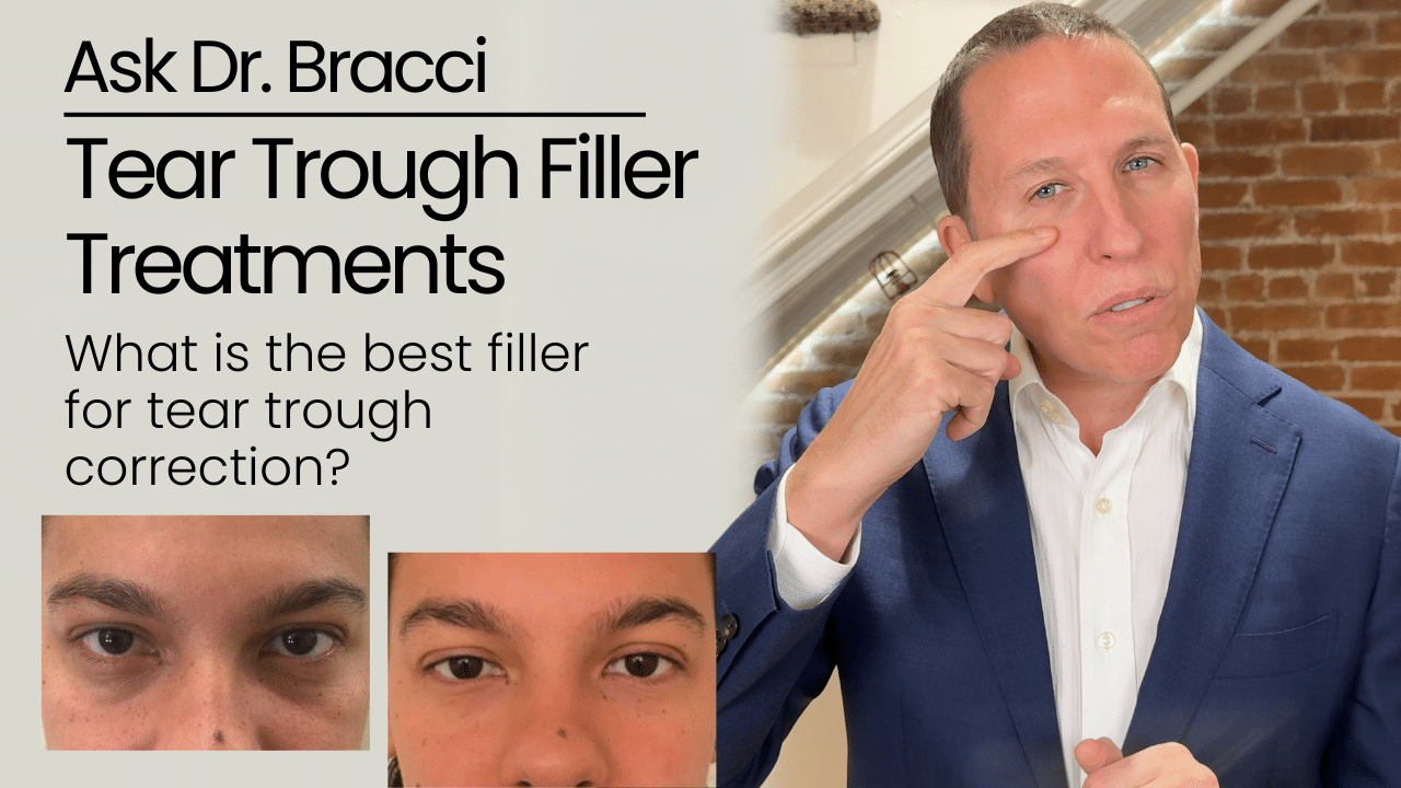 Tear Trough Filler Treatments: What is the best filler for tear trough correction?