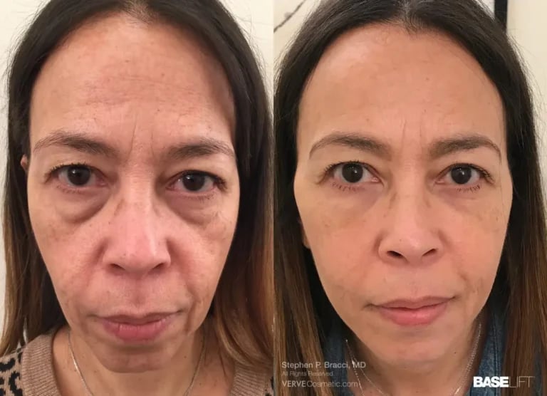 non-surgical-facelift-cosmetic-fillers-Stephen-Bracci-MD-1