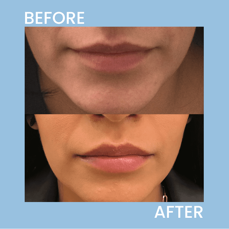 lip filler before and after photo, which is the best lip filler for you blog