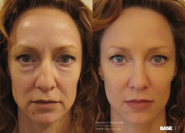 Cosmetic-Fillers-Non-Surgical-Face-Lift