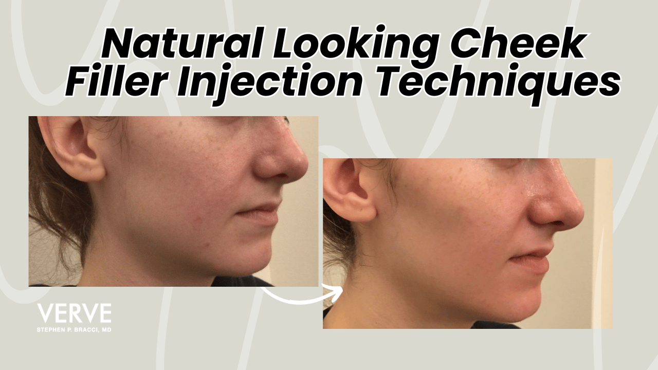 Natural-Looking Cheek Filler Injection Techniques for Older Adults | Everything You Need to Know for a More Youthful Face