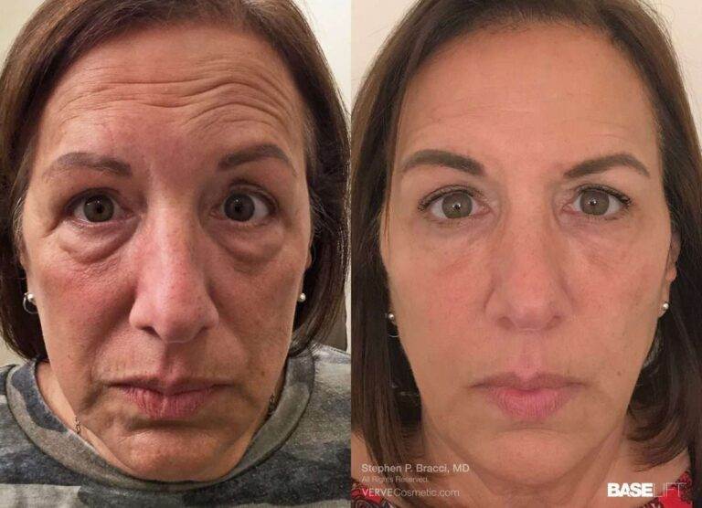 BASELIFT-Non Surgical Facelift NYC