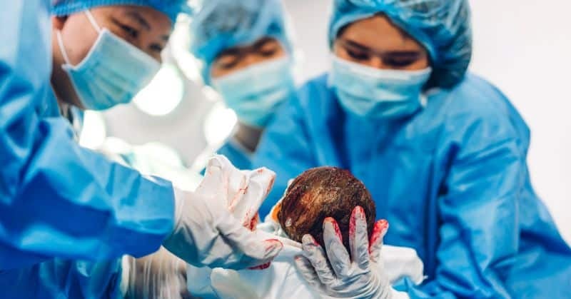 רשלנות רפואית בלידה טבעית