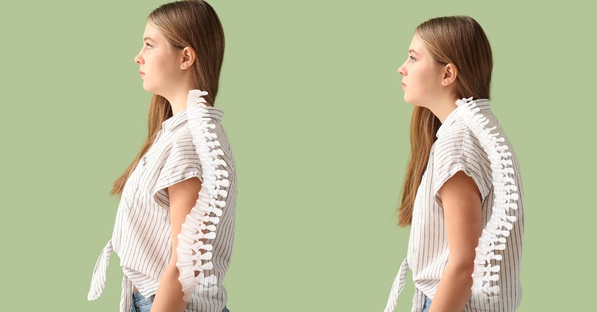 רשלנות רפואית סקוליוזיס מולד -   Congenital Scoliosis