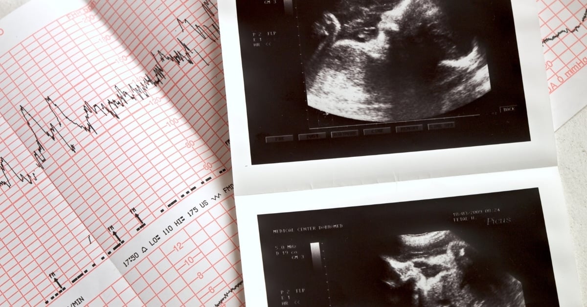 זכות עובר לתבוע בגין קיצור תוחלת חיים עקב רשלנות רפואית בלידה