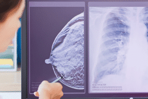 רשלנות רפואית באבחון סרטן השד