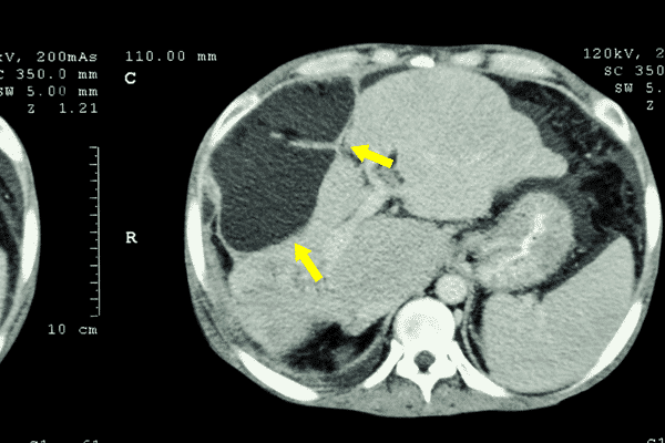 سوء الممارسة الطبية في سرطان الكبد – مراجعة شاملة