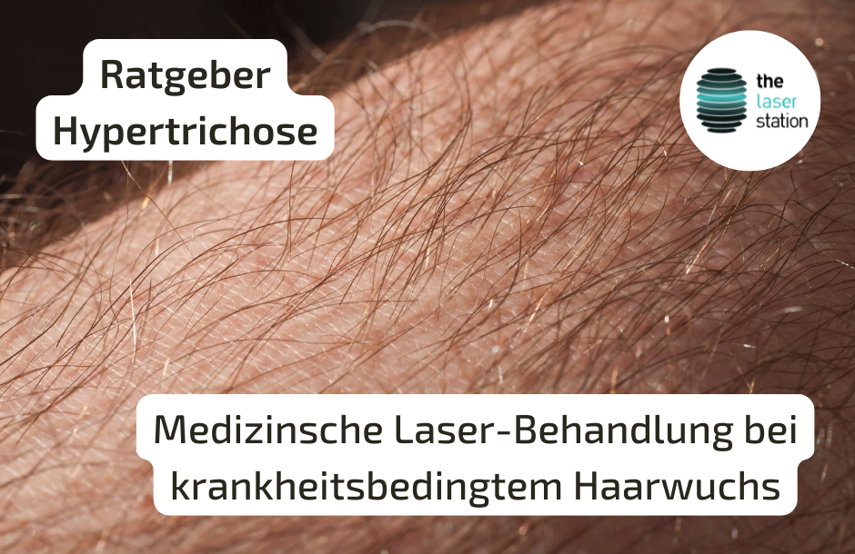 Ratgeber Laser-Haarentfernung bei Hypertrichose Blog-Post Grafik mit starker Körperbehaarung