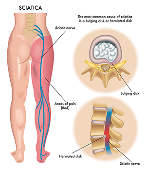 Can An Atlanta Chiropractor Help With Sciatica?